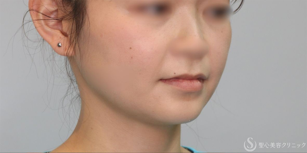 【20代女性・手軽に小顔に】ボツリヌストキシン注入（注射）（エラ）（術後1ヶ月） Before 