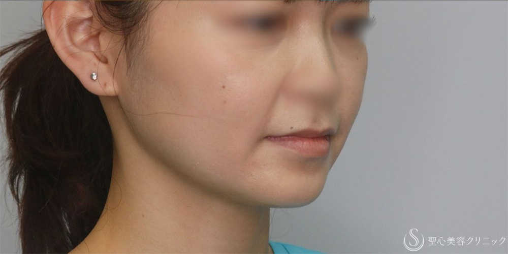 【20代女性・手軽に小顔に】ボツリヌストキシン注入（注射）（エラ）（術後1ヶ月） After 