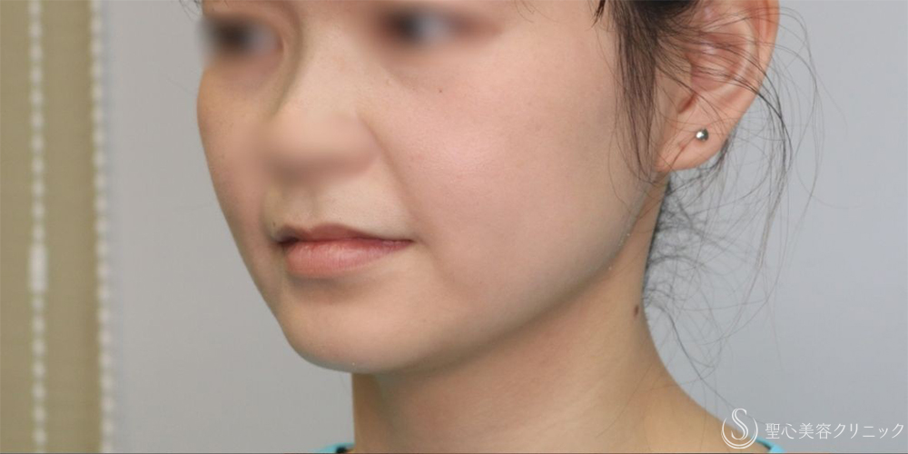 【20代女性・手軽に小顔に】ボツリヌストキシン注入（注射）（エラ）（術後1ヶ月） Before 