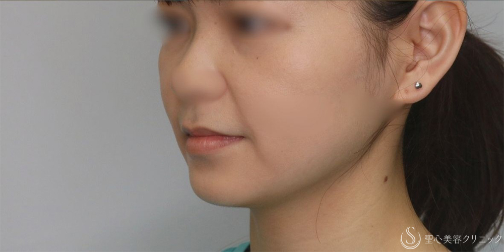 【20代女性・手軽に小顔に】ボツリヌストキシン注入（注射）（エラ）（術後1ヶ月） After 