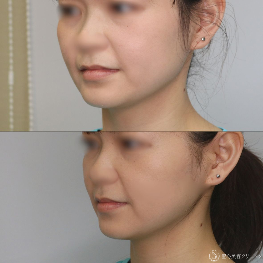 【20代女性・手軽に小顔に】ボツリヌストキシン注入（注射）（エラ）（術後1ヶ月） After 名古屋+小顔・エラのボトックス・切らない