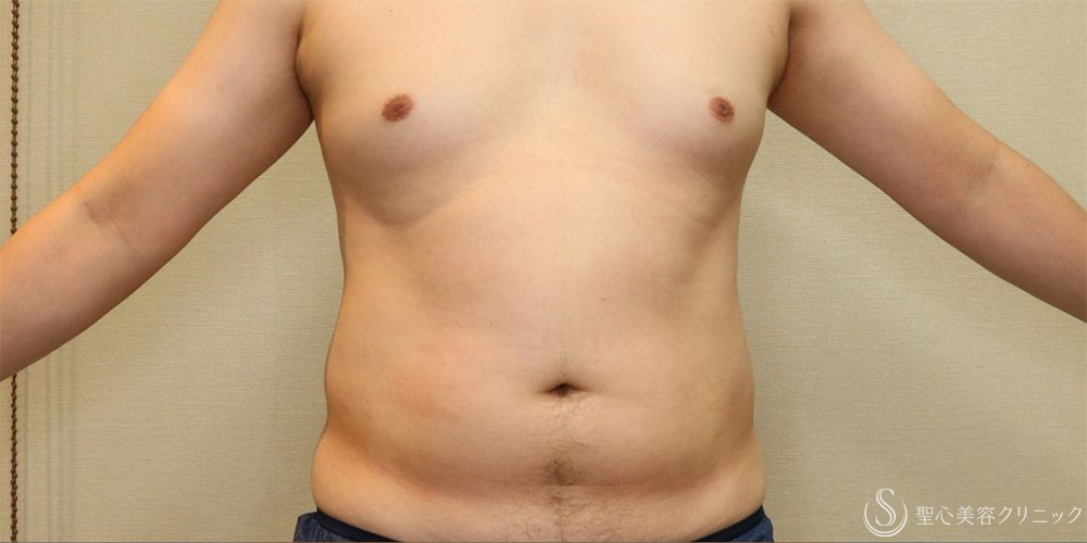 【30代男性・お腹周りの皮下脂肪をすっきりと】ベイザー脂肪吸引（腹部全周）（術後1ヶ月） Before 