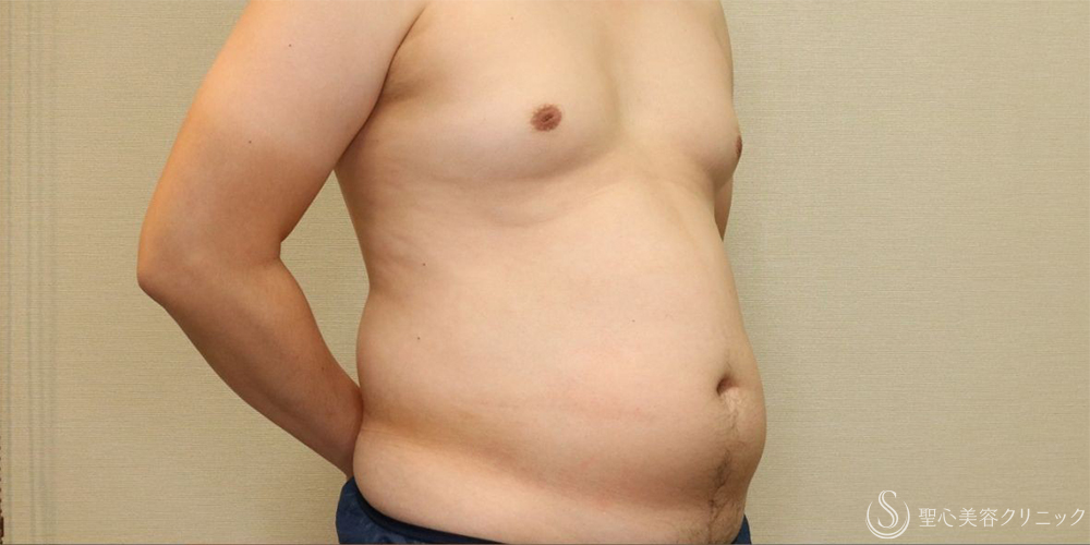 【30代男性・お腹周りの皮下脂肪をすっきりと】ベイザー脂肪吸引（腹部全周）（術後1ヶ月） Before 