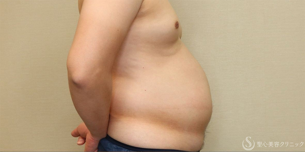【30代男性・お腹周りの皮下脂肪をすっきりと】ベイザー脂肪吸引（腹部全周）（術後1ヶ月） Before 