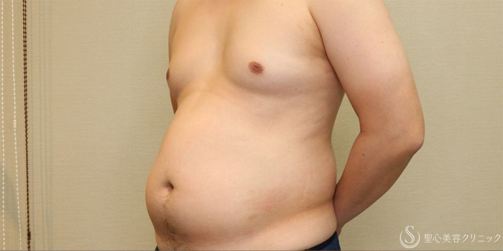 【30代男性・お腹周りの皮下脂肪をすっきりと】ベイザー脂肪吸引（腹部全周）（術後1ヶ月） Before 