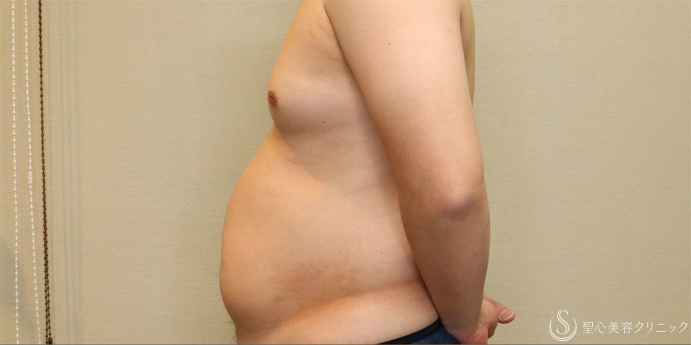 【30代男性・お腹周りの皮下脂肪をすっきりと】ベイザー脂肪吸引（腹部全周）（術後1ヶ月） Before 