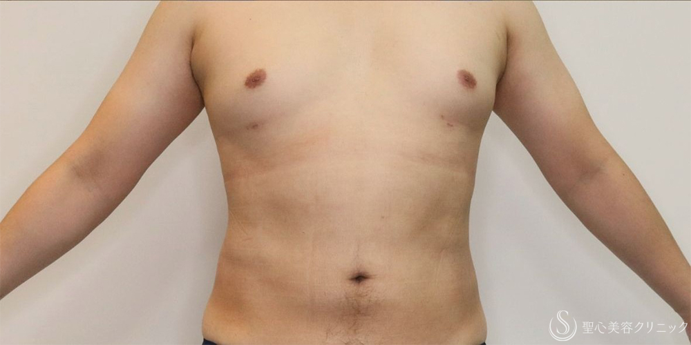 【30代男性・お腹周りの皮下脂肪をすっきりと】ベイザー脂肪吸引（腹部全周）（術後1ヶ月） After 