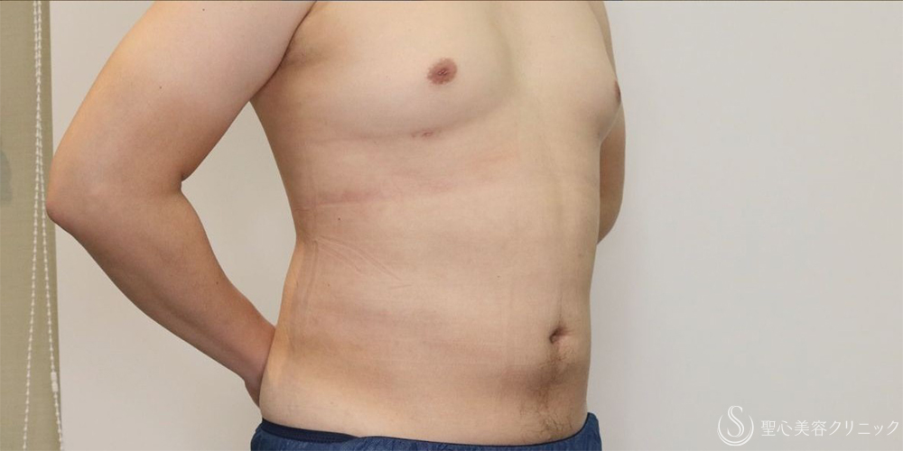 【30代男性・お腹周りの皮下脂肪をすっきりと】ベイザー脂肪吸引（腹部全周）（術後1ヶ月） After 