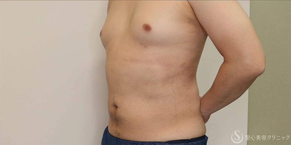 【30代男性・お腹周りの皮下脂肪をすっきりと】ベイザー脂肪吸引（腹部全周）（術後1ヶ月） After 