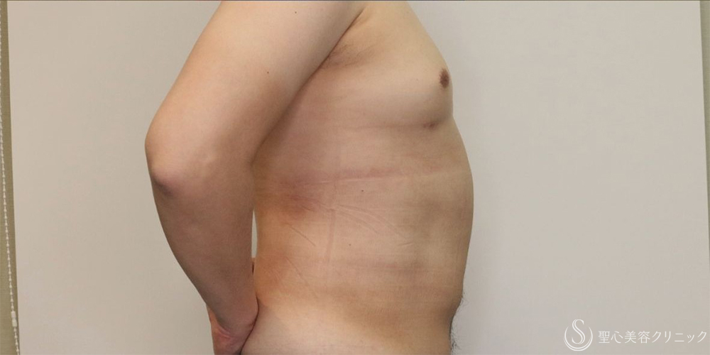【30代男性・お腹周りの皮下脂肪をすっきりと】ベイザー脂肪吸引（腹部全周）（術後1ヶ月） After 
