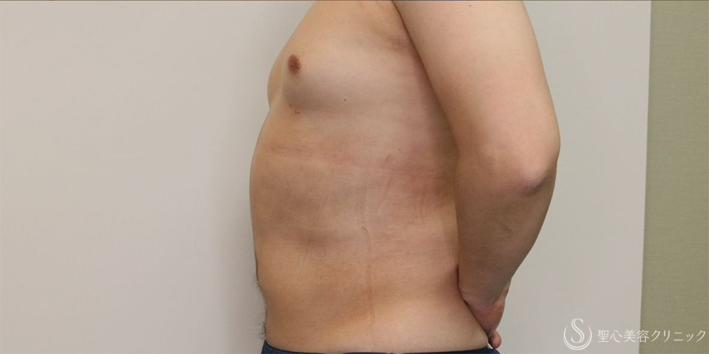 【30代男性・お腹周りの皮下脂肪をすっきりと】ベイザー脂肪吸引（腹部全周）（術後1ヶ月） After 