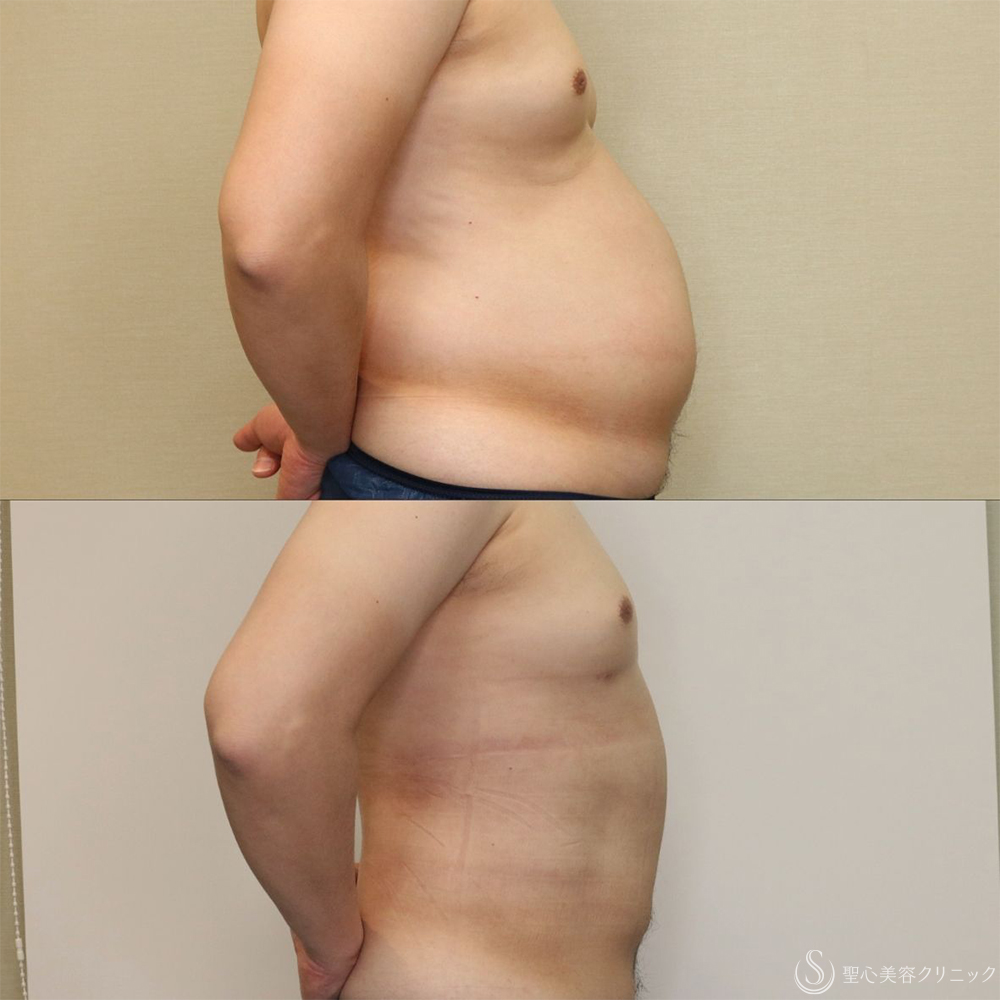 【30代男性・お腹周りの皮下脂肪をすっきりと】ベイザー脂肪吸引（腹部全周）（術後1ヶ月） After 名古屋+脂肪吸引・お腹すっきり