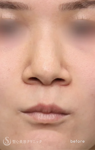 【20代女性・傷跡が目立ちにくく、形にも妥協しない小鼻に】小鼻縮小術（3ヶ月後） Before 