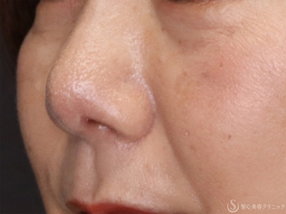【50代女性・鼻の穴を目立たなく】鼻孔縁下降術（術後1ヶ月） After 