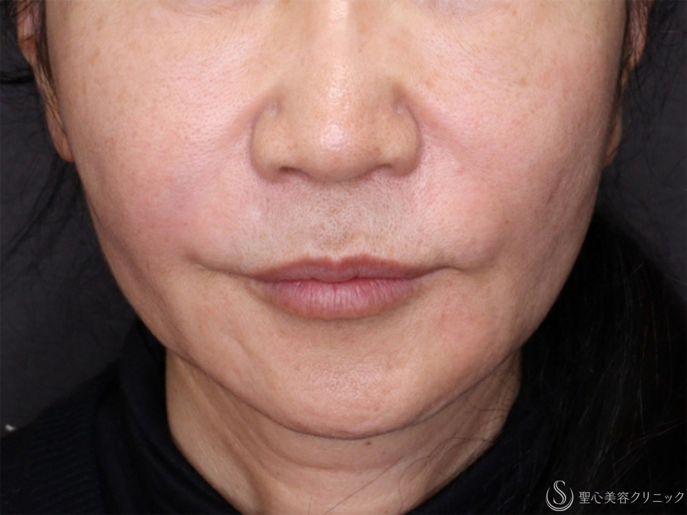 肌育スレッド（PDRN モノ）_Before