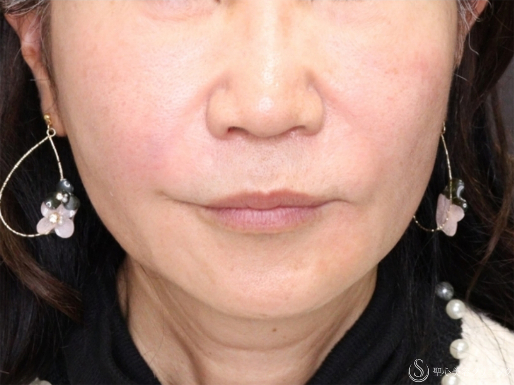 肌育スレッド（PDRN モノ）_After