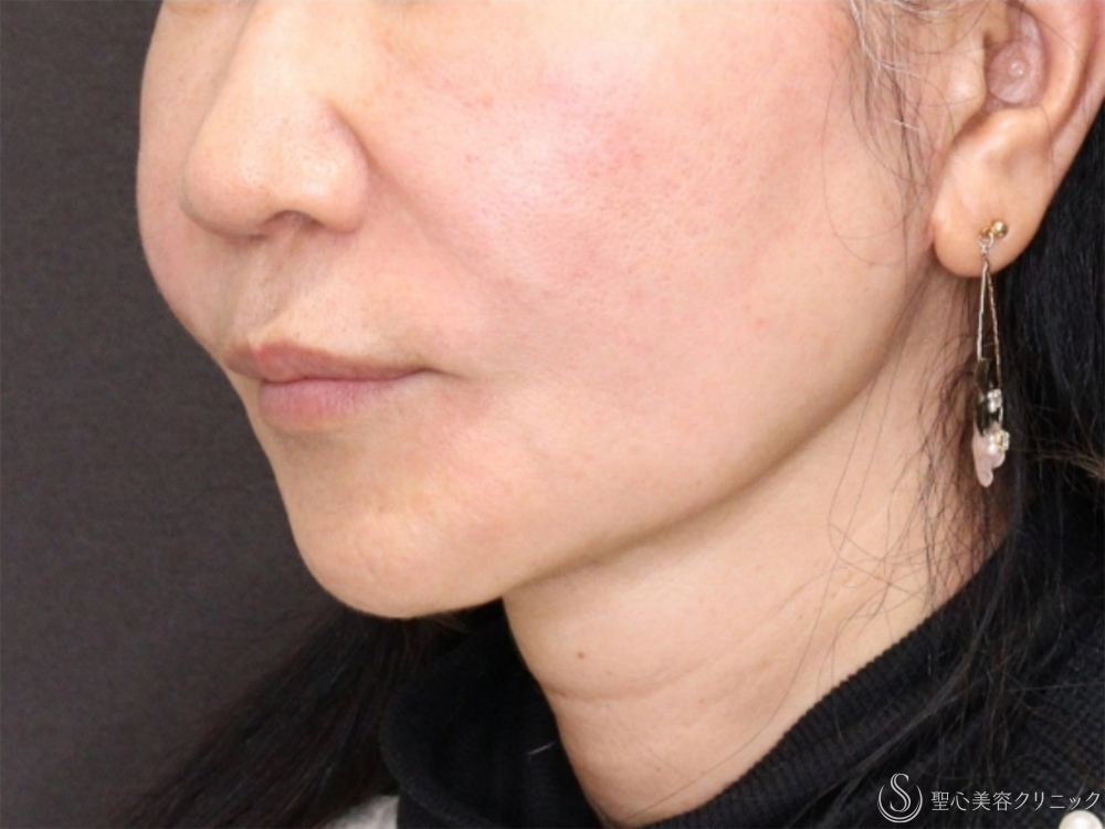 【60代女性・自然な頬の若返り】PDRNモノスレッド（50本）（術後1ヶ月） After 