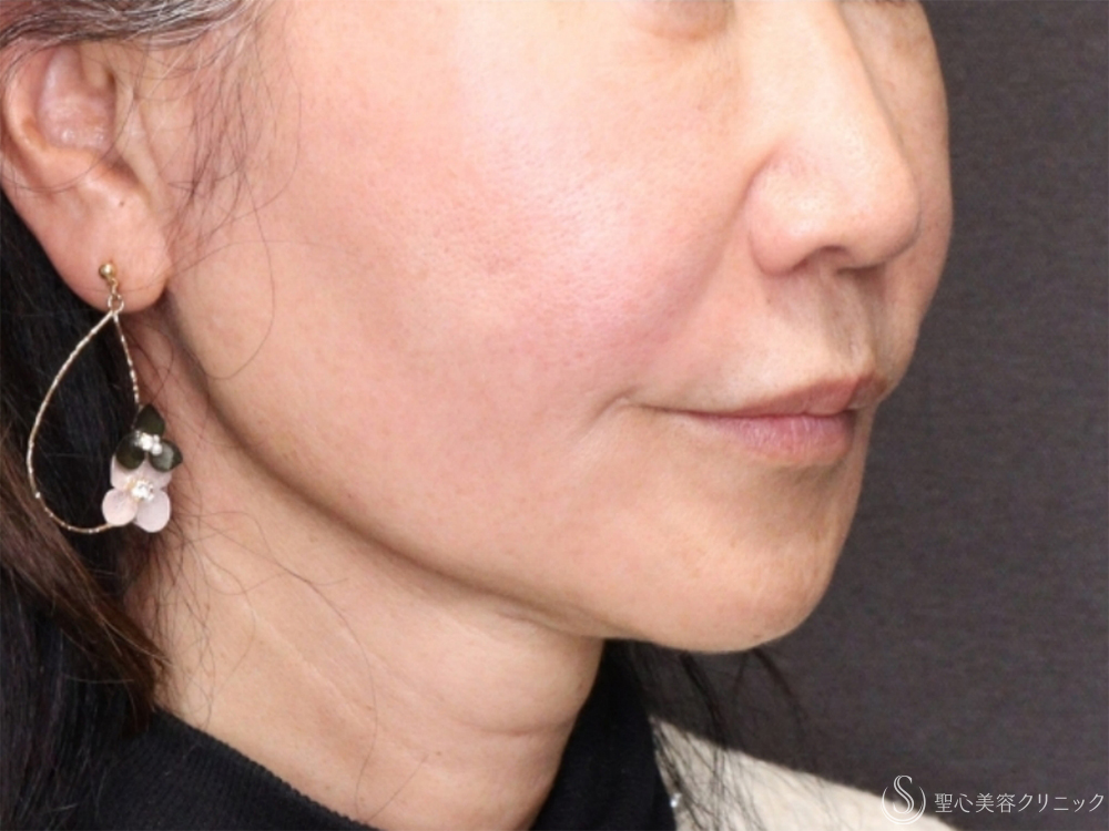 【60代女性・自然な頬の若返り】PDRNモノスレッド（50本）（術後1ヶ月） After 
