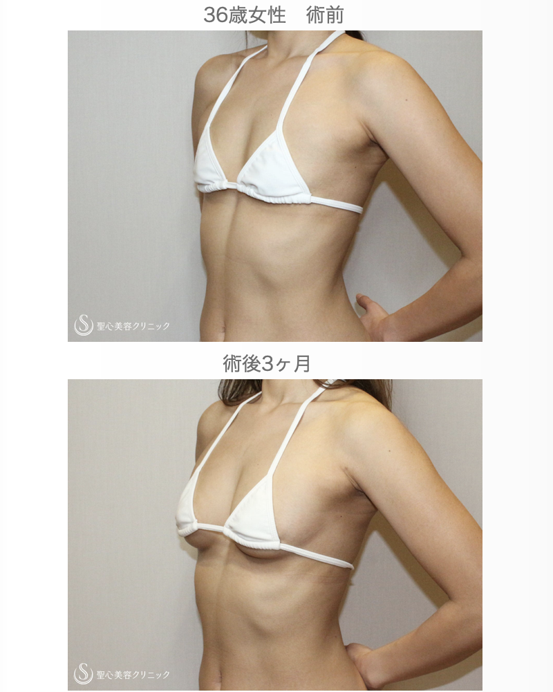 【36歳女性・脂肪注入でバッグ級の仕上がり】プレミアムセリューション豊胸術（3ヶ月後） After 