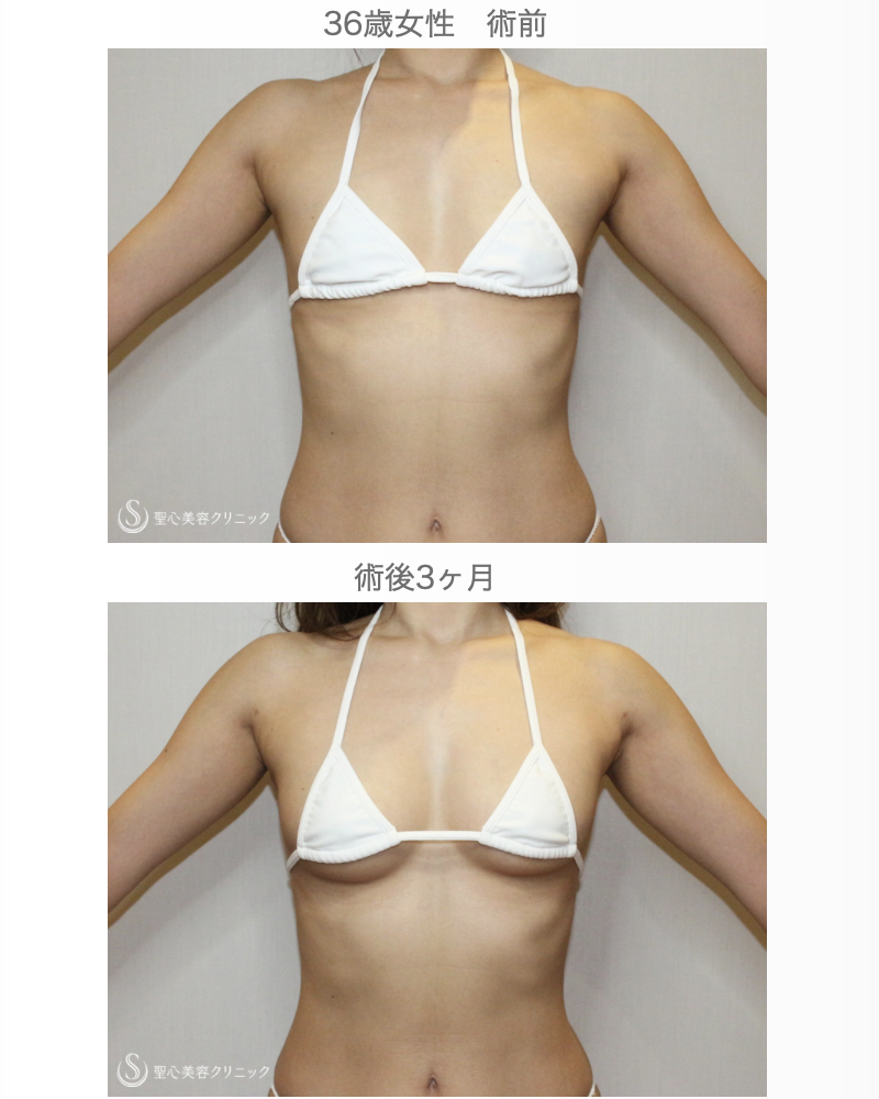 【36歳女性・脂肪注入でバッグ級の仕上がり】プレミアムセリューション豊胸術（3ヶ月後） After 