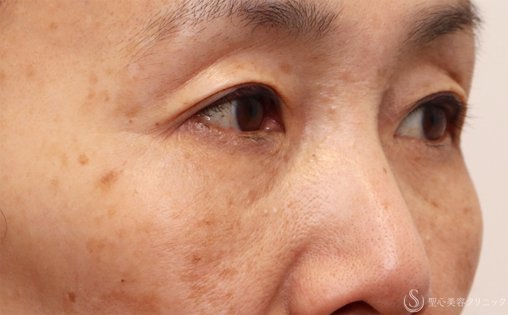 【60代女性・切らないクマ取り】目の下の脂肪取り（経結膜下脱脂法）（1ヶ月後） After 