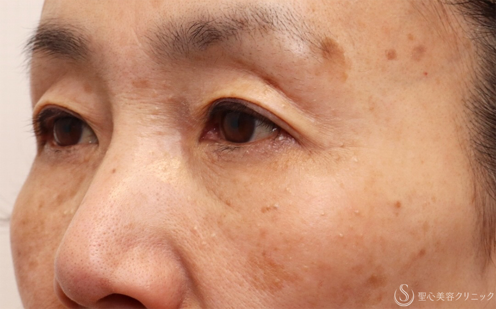 【60代女性・切らないクマ取り】目の下の脂肪取り（経結膜下脱脂法）（1ヶ月後） After 