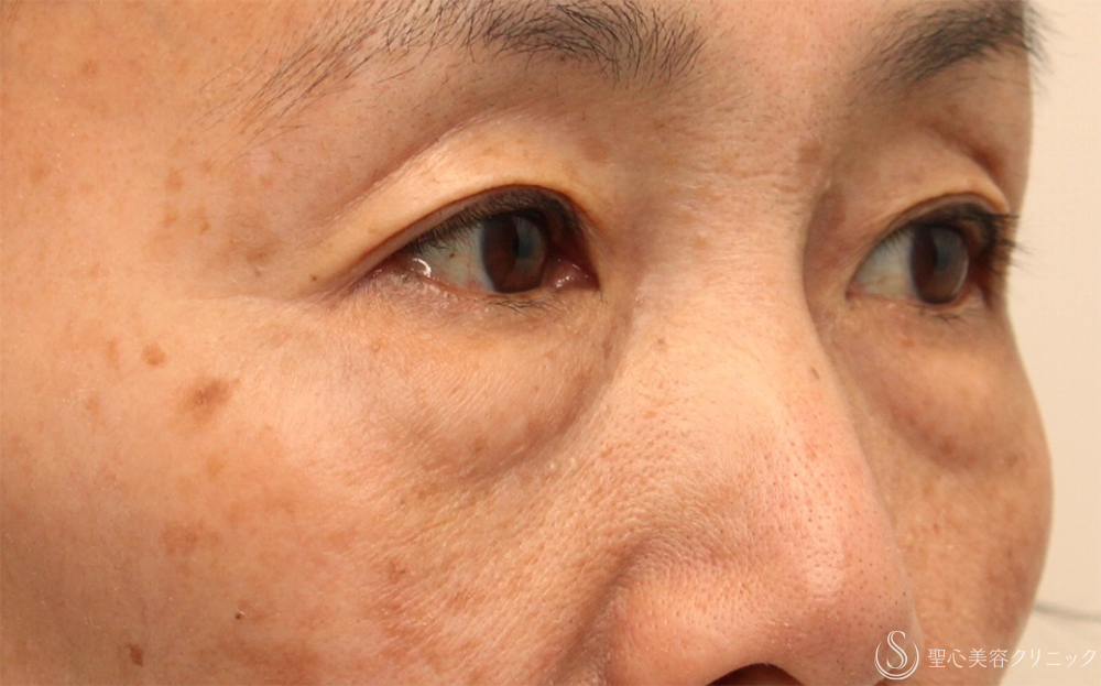 【60代女性・切らないクマ取り】目の下の脂肪取り（経結膜下脱脂法）（1ヶ月後） Before 
