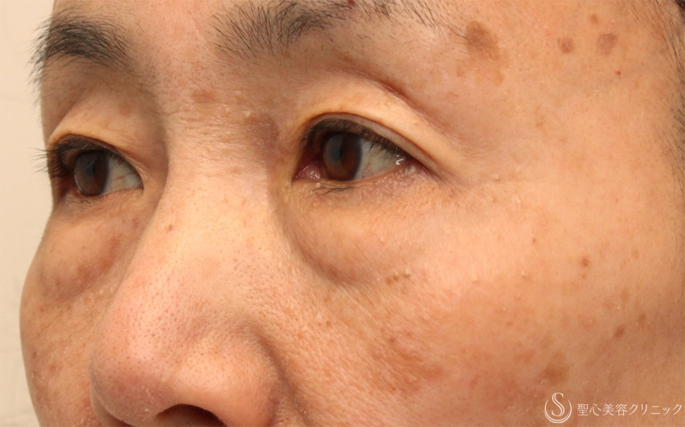 【60代女性・切らないクマ取り】目の下の脂肪取り（経結膜下脱脂法）（1ヶ月後） Before 