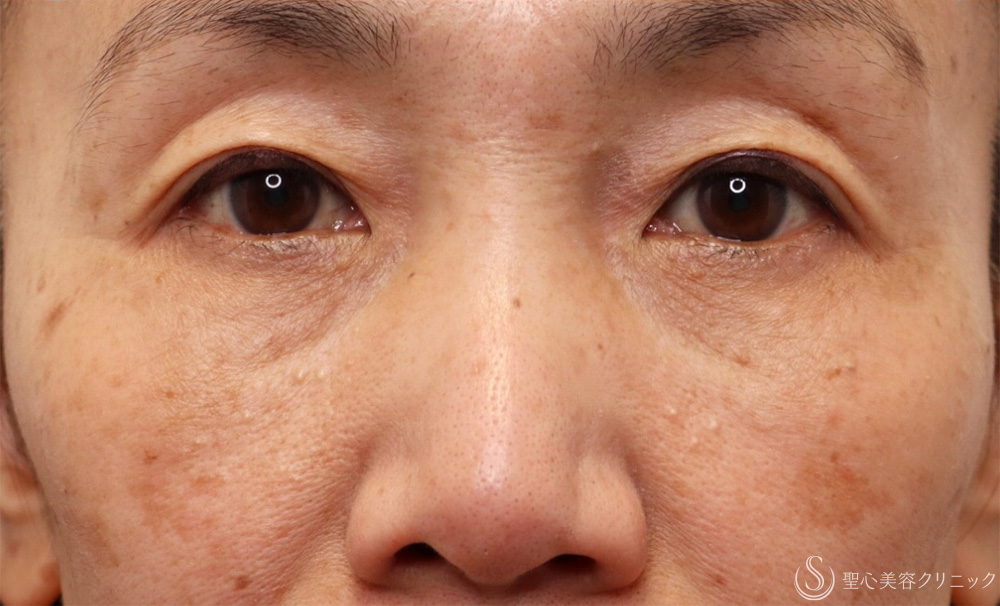 【60代女性・切らないクマ取り】目の下の脂肪取り（経結膜下脱脂法）（1ヶ月後） After 