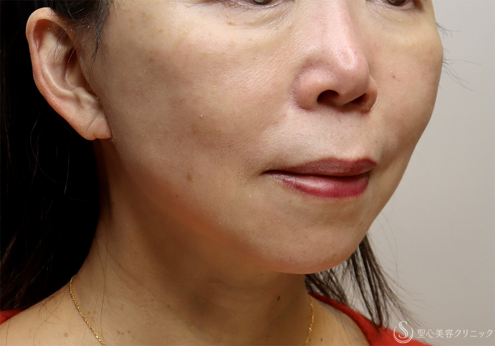 【50代女性・顔の弛みを改善】エクステンデッドディーププレーンフェイスリフト（2ヶ月後）　 After 