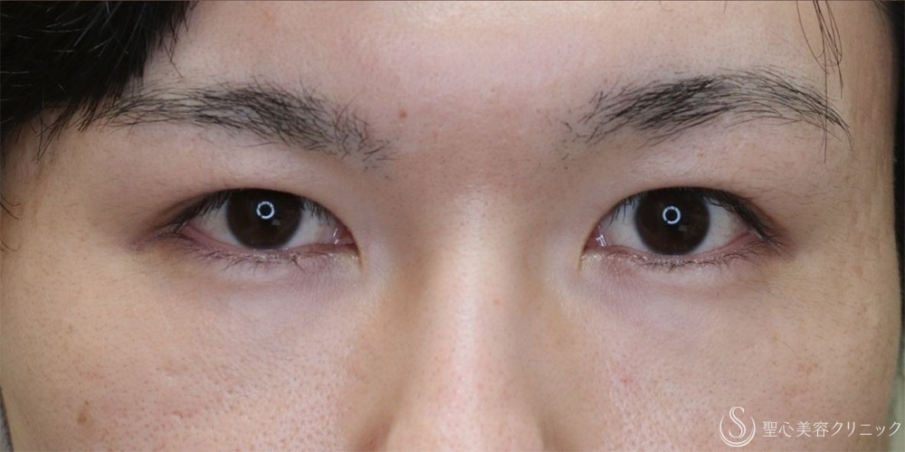 【20代男性・目の開きを改善】眼瞼下垂切開＋他院埋没糸抜糸（2ヶ月後） After 名古屋+二重　埋没法　眼瞼下垂