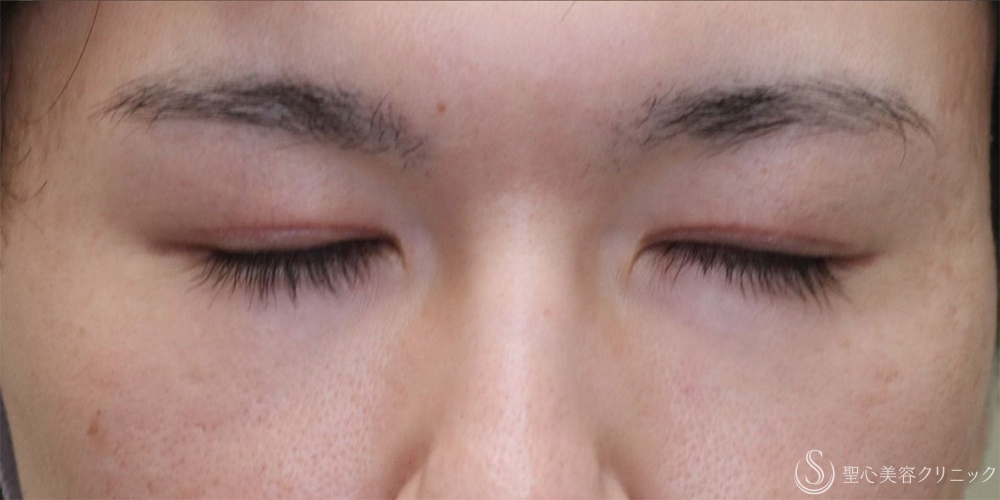 【20代男性・目の開きを改善】眼瞼下垂切開＋他院埋没糸抜糸（2ヶ月後） After 名古屋+二重　埋没法　眼瞼下垂