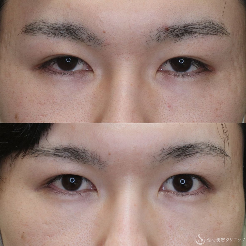 【20代男性・目の開きを改善】眼瞼下垂切開＋他院埋没糸抜糸（2ヶ月後） After 名古屋+二重　埋没法　眼瞼下垂
