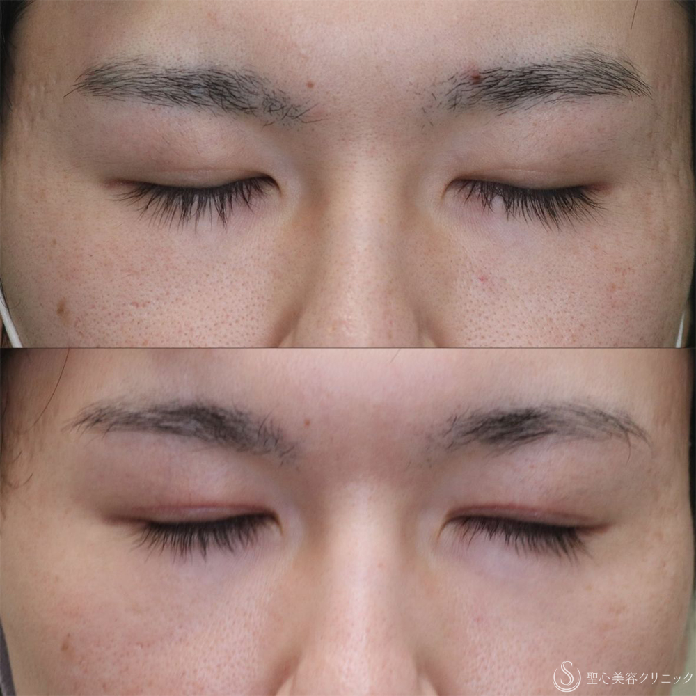 【20代男性・目の開きを改善】眼瞼下垂切開＋他院埋没糸抜糸（2ヶ月後） After 名古屋+二重　埋没法　眼瞼下垂