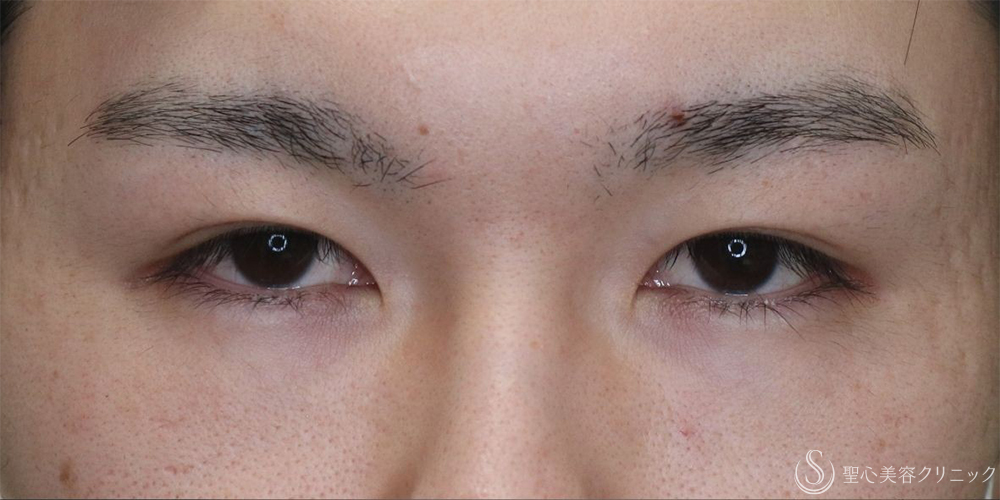 【20代男性・目の開きを改善】眼瞼下垂切開＋他院埋没糸抜糸（2ヶ月後） Before 名古屋+二重　埋没法　眼瞼下垂