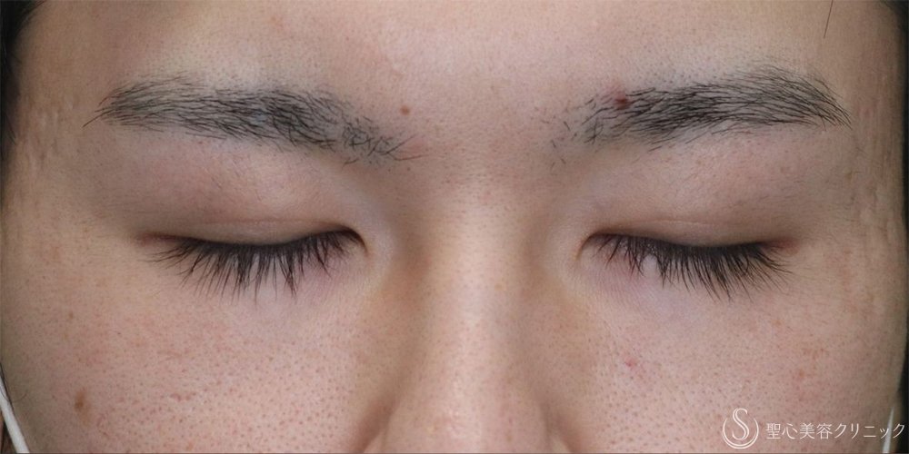 【20代男性・目の開きを改善】眼瞼下垂切開＋他院埋没糸抜糸（2ヶ月後） Before 名古屋+二重　埋没法　眼瞼下垂