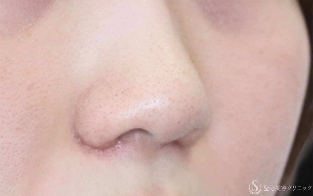 【20代女性・一回り小さくなって自然な小鼻に】小鼻縮小（内外法）（1ヶ月後） After 