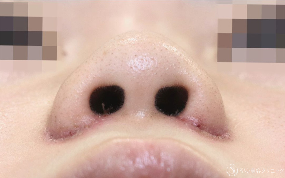 【20代女性・一回り小さくなって自然な小鼻に】小鼻縮小（内外法）（1ヶ月後） After 