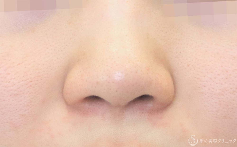 【20代女性・一回り小さくなって自然な小鼻に】小鼻縮小（内外法）（1ヶ月後） Before 