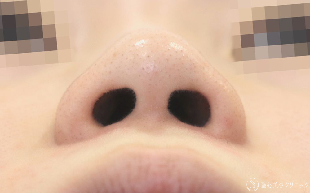 【20代女性・一回り小さくなって自然な小鼻に】小鼻縮小（内外法）（1ヶ月後） Before 