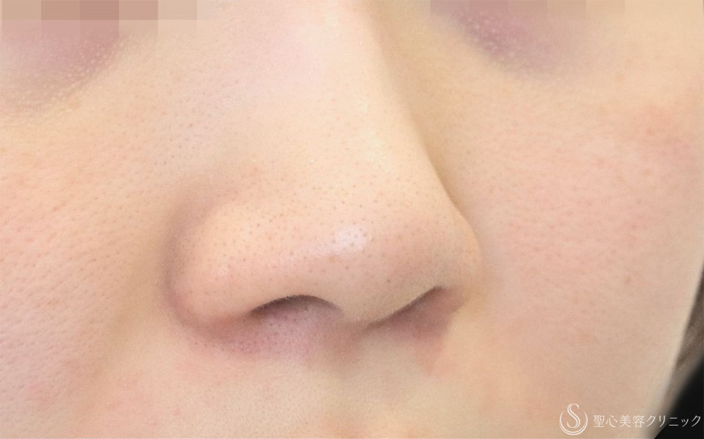 【20代女性・一回り小さくなって自然な小鼻に】小鼻縮小（内外法）（1ヶ月後） Before 
