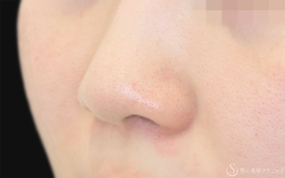 【20代女性・一回り小さくなって自然な小鼻に】小鼻縮小（内外法）（1ヶ月後） Before 