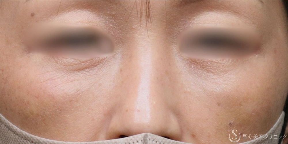 【40代女性・目の下の膨らみ改善】目の下の脂肪取り（1ヶ月後） After 名古屋+目の下のくまとり・目の下のくま・たるみ