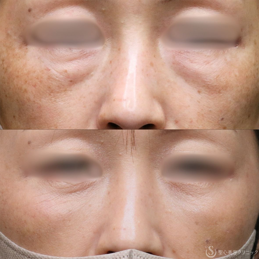 【40代女性・目の下の膨らみ改善】目の下の脂肪取り（1ヶ月後） After 名古屋+目の下のくまとり・目の下のくま・たるみ