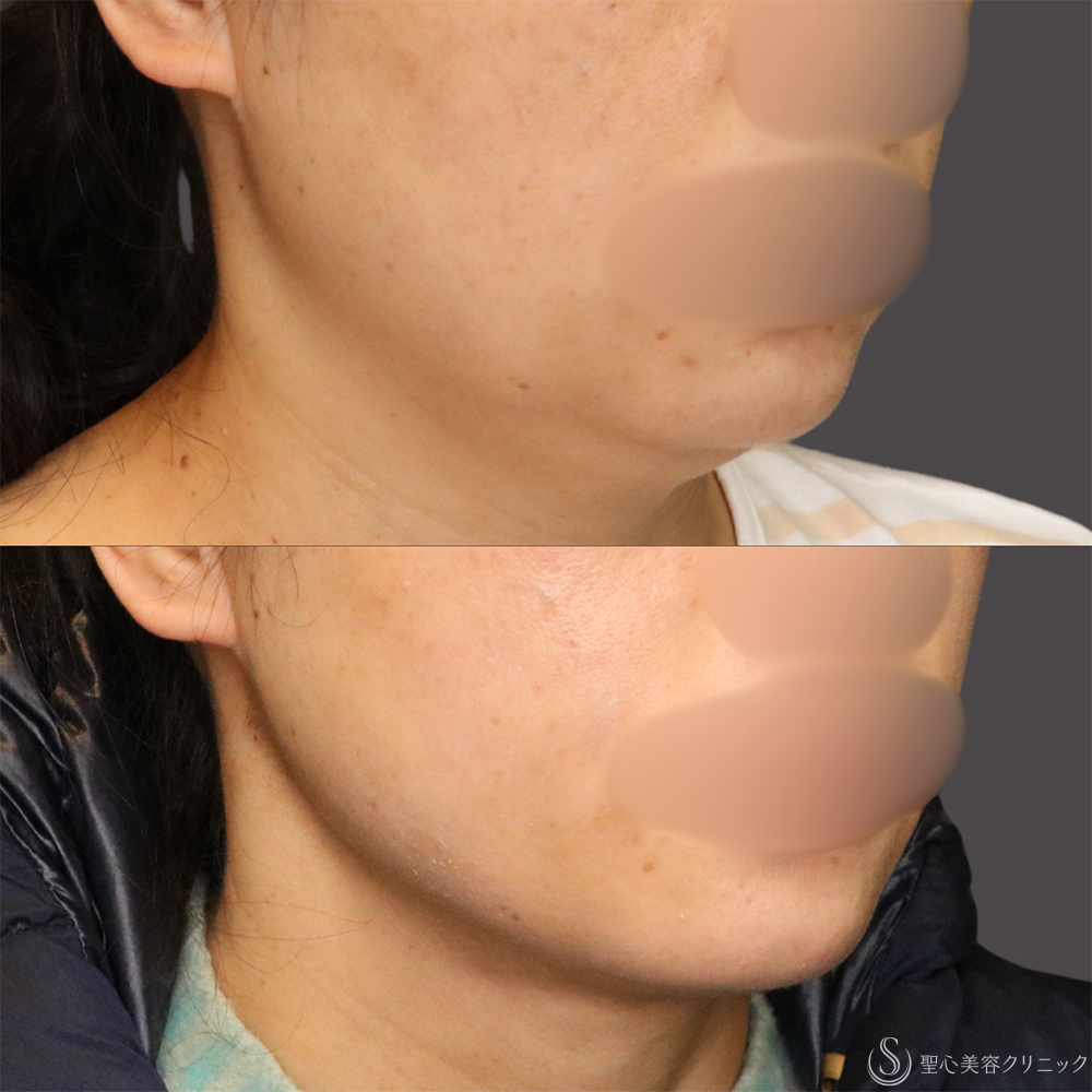 【40代女性・フェイスラインと二重顎がスッキリ】脂肪吸引（頬・顎下）（5ヶ月後） After 名古屋+たるみ　もたつき　アンチエイジング