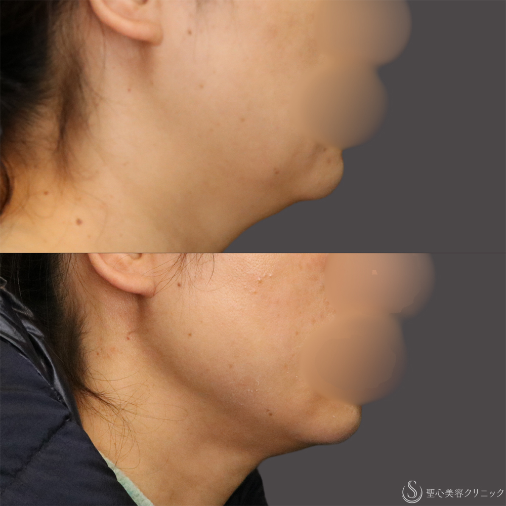 【40代女性・フェイスラインと二重顎がスッキリ】脂肪吸引（頬・顎下）（5ヶ月後） After 名古屋+たるみ　もたつき　アンチエイジング