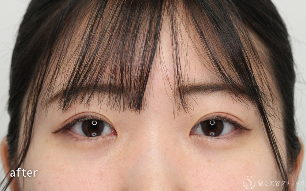 【20代女性・腫れが少なく自然なラインを実現】二重術（埋没法）：マイクロメソッド+α（1ヶ月後） After 