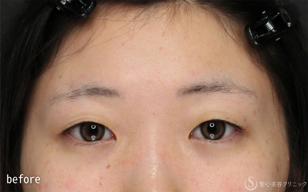 【20代女性・腫れが少なく自然なラインを実現】二重術（埋没法）：マイクロメソッド+α（1ヶ月後） Before 