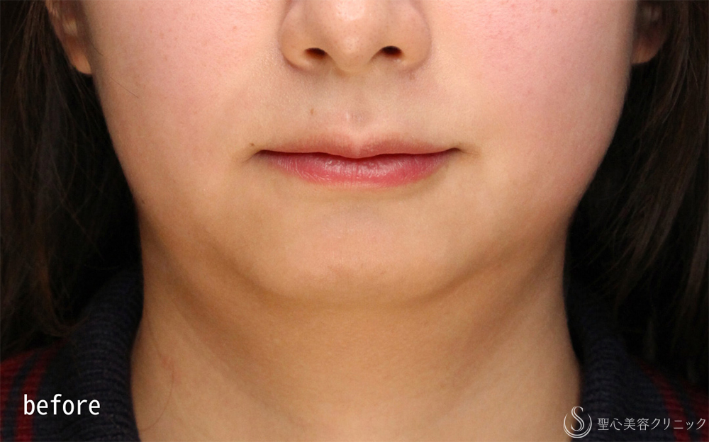 【20代女性・切らない顎下痩せ】ドクターハイフ（ウルトラセル[zíː]）（リニアハイフ）（1ヶ月後） Before 