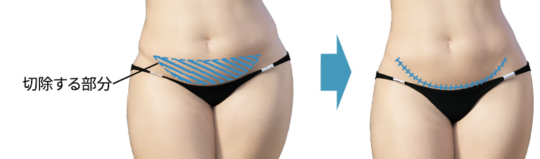 下腹部皮膚切除